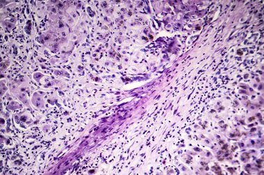 Postnecrotic karaciğer sirozu hipopatolojisi