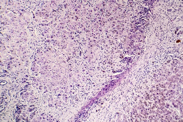 Histopatologie postnekrotické jaterní cirhózy — Stock fotografie
