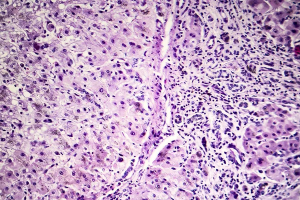 Histopatologie postnekrotické jaterní cirhózy — Stock fotografie