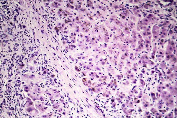 Histopatología de la cirrosis hepática postnecrótica — Foto de Stock