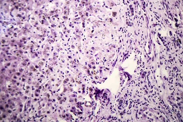 閉経後肝肝硬変の組織病理学 — ストック写真