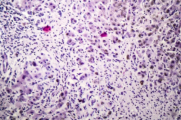 閉経後肝肝硬変の組織病理学 — ストック写真