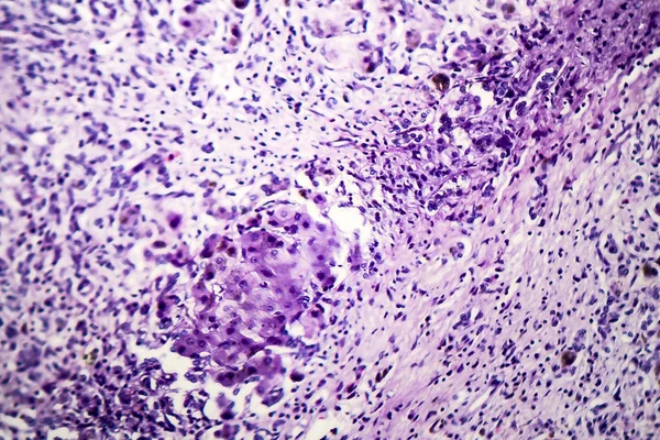 Histopathology of postnecrotic liver cirrhosis — Stock Photo, Image