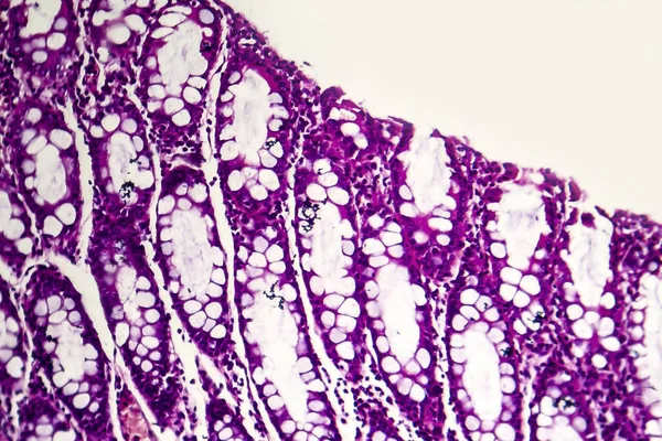 Βακτηριακή δυσεντερία, ελαφρύ μικρογράφημα — Φωτογραφία Αρχείου