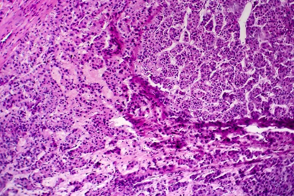 Hepatocellularis carcinoma, fénymikrográf — Stock Fotó