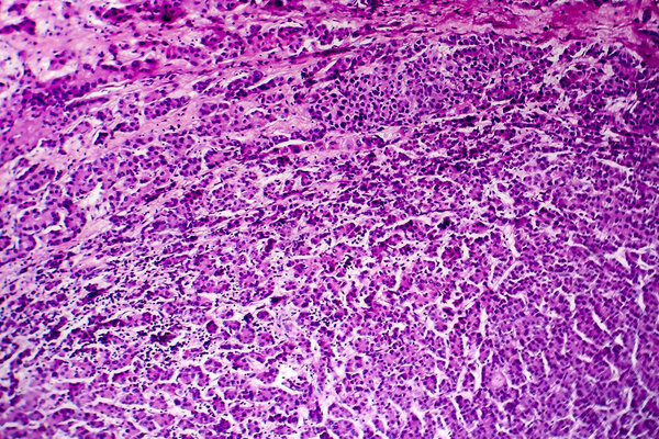 Hepatocellular carcinoma, light micrograph