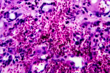 İnce bağırsak iltihabı, ışık mikrografı, mikroskop altında fotoğraf. Yüksek büyütme