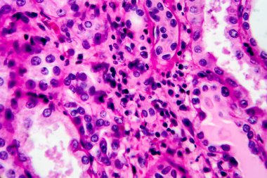 Kronik piyelonefrit, hafif mikrograf, mikroskop altında fotoğraf. Yüksek büyütme