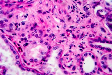 Kronik piyelonefrit, hafif mikrograf, mikroskop altında fotoğraf. Yüksek büyütme