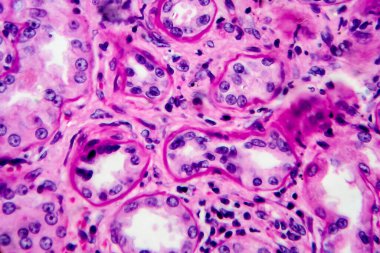 Kronik piyelonefrit, hafif mikrograf, mikroskop altında fotoğraf. Yüksek büyütme