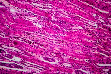 Akut piyelonefrit, hafif mikrograf, mikroskop altında fotoğraf.