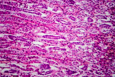 Akut piyelonefrit, hafif mikrograf, mikroskop altında fotoğraf.