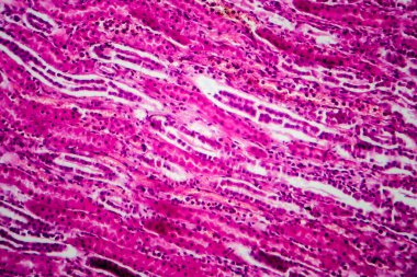 Akut piyelonefrit, hafif mikrograf, mikroskop altında fotoğraf.