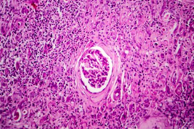 Kronik glomerulonefrit, ışık mikrografı, mikroskop altında fotoğraf.