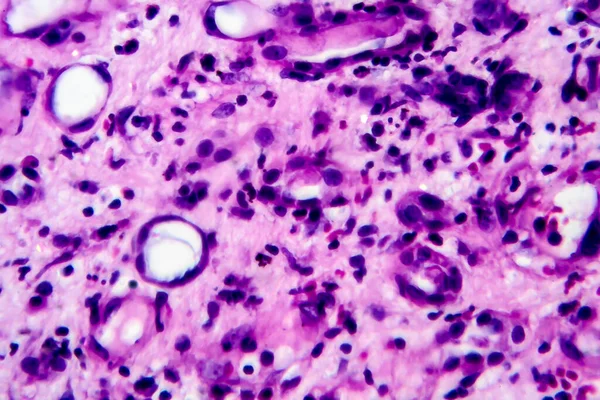 Histopatologia Śródmiąższowego Zapalenia Nerek Mikrograf Świetlny Zdjęcie Pod Mikroskopem Duże — Zdjęcie stockowe