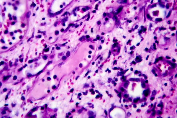 Histopatología Nefrotis Intersticial Micrografía Ligera Foto Microscopio Alta Magnificación — Foto de Stock