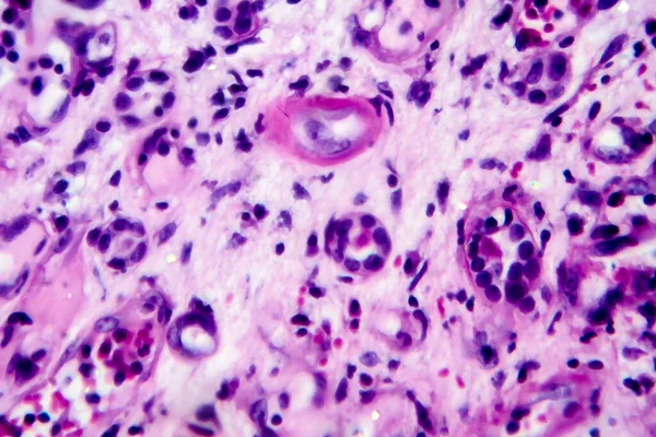 Histopatologia Nefrite Intersticial Micrografia Leve Foto Sob Microscópio Elevada Ampliação — Fotografia de Stock