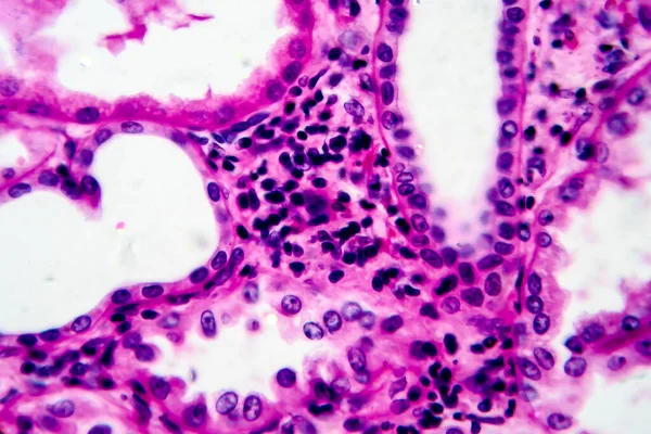 Chronic pyelonephritis, light micrograph, photo under microscope. High magnification