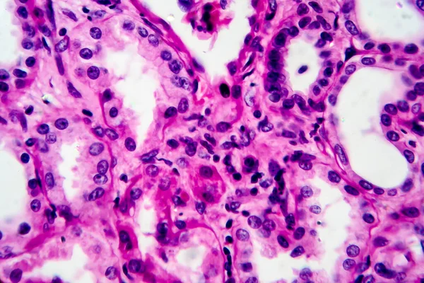 Chronische Pyelonephritis Lichtmikroskopie Foto Unter Dem Mikroskop Hohe Vergrößerung — Stockfoto