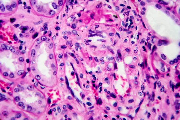 Chronic pyelonephritis, light micrograph, photo under microscope. High magnification