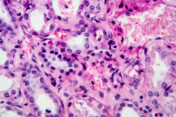 Χρόνια Πυελονεφρίτιδα Μικρογραφία Φωτός Φωτογραφία Στο Μικροσκόπιο Υψηλή Μεγέθυνση — Φωτογραφία Αρχείου
