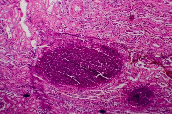 Pielonefritis Aguda Micrografía Ligera Foto Microscopio — Foto de Stock