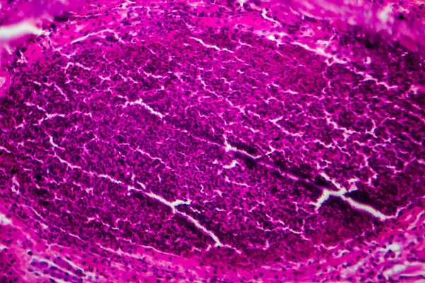 Pielonefrite Acuta Micrografo Leggero Foto Microscopio — Foto Stock