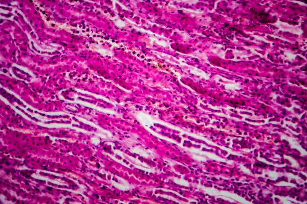 Οξεία Πυελονεφρίτιδα Μικρογραφία Φωτός Φωτογραφία Στο Μικροσκόπιο — Φωτογραφία Αρχείου