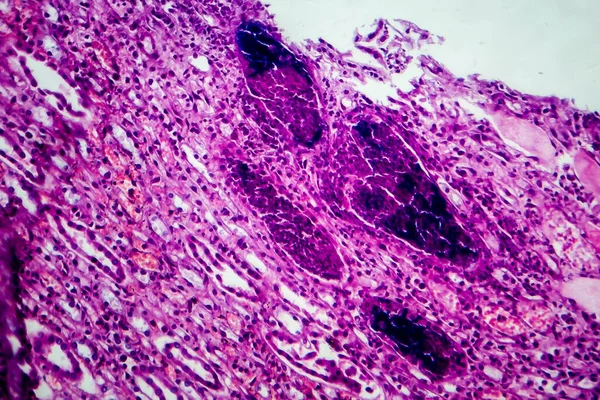 Pielonefritis Aguda Micrografía Ligera Foto Microscopio —  Fotos de Stock