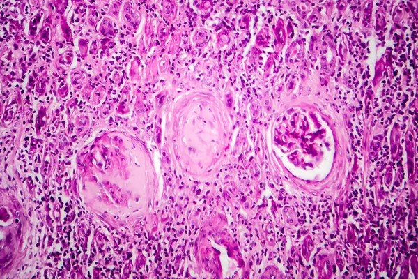 Chronická Glomerulonefritida Světelný Mikrograf Fotografie Pod Mikroskopem — Stock fotografie