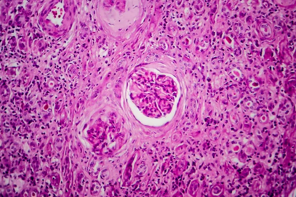 Chronická Glomerulonefritida Světelný Mikrograf Fotografie Pod Mikroskopem — Stock fotografie
