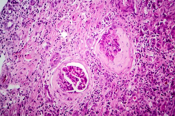 慢性糸球体腎炎 軽いマイクログラフ 顕微鏡下の写真 — ストック写真
