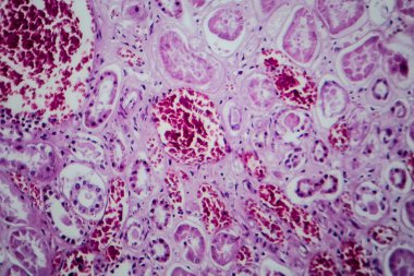 Akut glomerulonefrit, hafif mikrograf, mikroskop altında fotoğraf.
