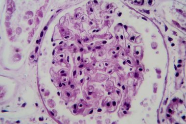 Acute glomerulonephritis, light micrograph, photo under microscope. High magnification clipart