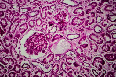Yaygın skleroz glomerulonefrit, ışık mikrografı, mikroskop altında fotoğraf.