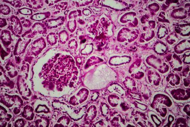 Histopathology of diffuse sclerosing glomerulonephritis, light micrograph, photo under microscope clipart