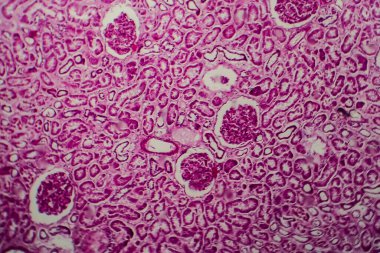 Histopathology of diffuse sclerosing glomerulonephritis, light micrograph, photo under microscope clipart