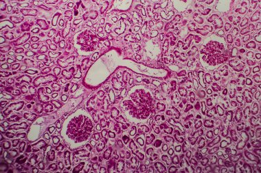 Yaygın skleroz glomerulonefrit, ışık mikrografı, mikroskop altında fotoğraf.