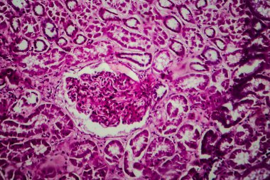 Yaygın skleroz glomerulonefrit, ışık mikrografı, mikroskop altında fotoğraf.
