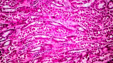 Yaygın skleroz glomerulonefrit, ışık mikrografı, mikroskop altında fotoğraf.