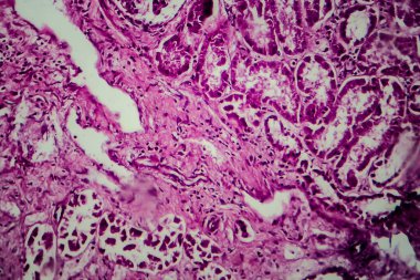 Yaygın skleroz glomerulonefrit, ışık mikrografı, mikroskop altında fotoğraf.