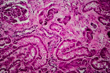 Yaygın skleroz glomerulonefrit, ışık mikrografı, mikroskop altında fotoğraf.
