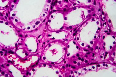 Tüplü atrofi, hafif mikrograf, mikroskop altında fotoğraf. Yüksek büyütme