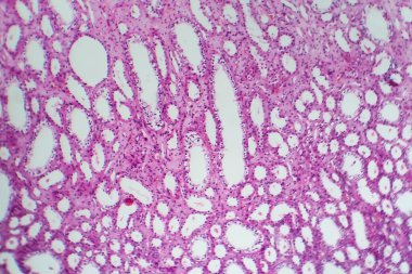 Tüplü atrofi, hafif mikrograf, mikroskop altında fotoğraf.