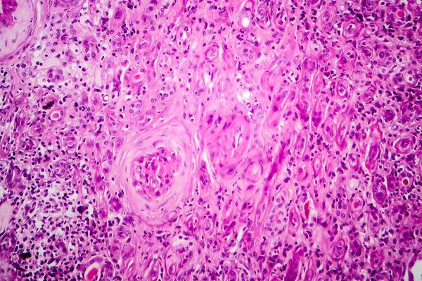 Chronic glomerulonephritis, light micrograph, photo under microscope