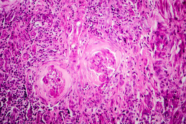 Chronic glomerulonephritis, light micrograph, photo under microscope