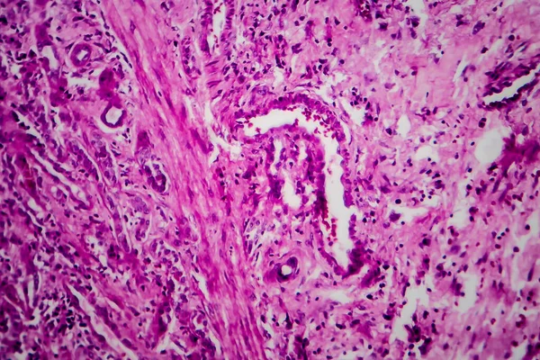 Chronická Glomerulonefritida Světelný Mikrograf Fotografie Pod Mikroskopem — Stock fotografie