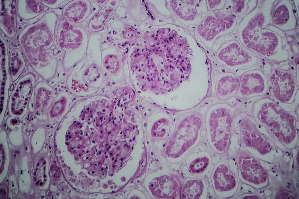 Akut Glomerulonephritis Fénymikrográf Fénykép Mikroszkóp Alatt — Stock Fotó