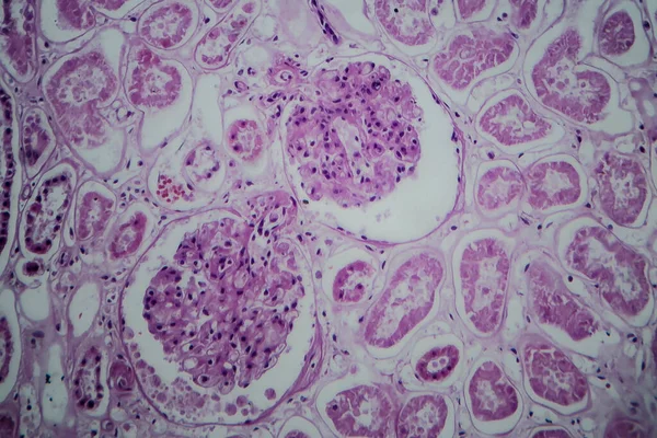 急性肾小球肾炎 光镜下摄影 — 图库照片