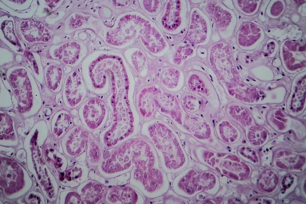 Glomerulonefrite Acuta Micrografo Leggero Foto Microscopio — Foto Stock